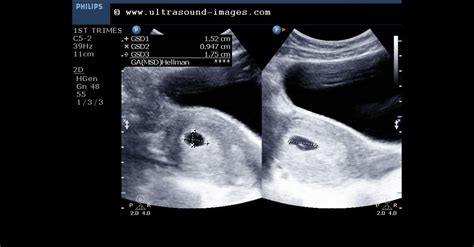 4:27 min | 20,883,740 views. . 5 weeks pregnant ultrasound showed nothing babycenter